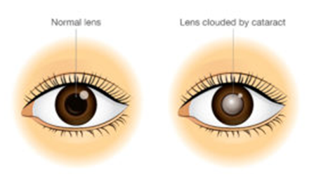Normal lens and Cataract leens