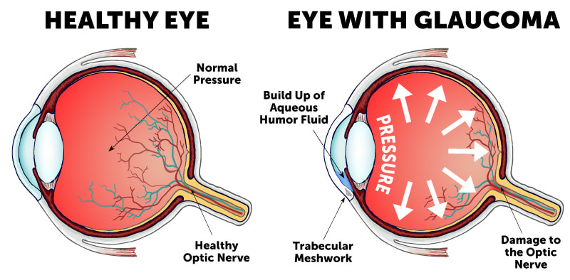DIFFERENT TYPES OF GLAUCOMA
