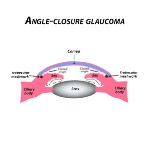 Angle-Closure Glaucoma