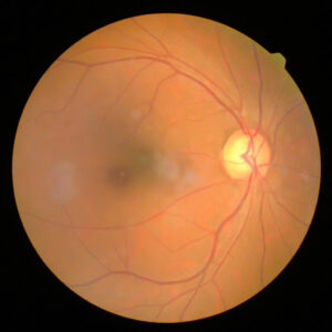 Normal-Tension Glaucoma