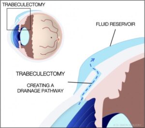 Trabeculectomy surgery