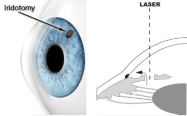 YAG Laser Peripheral Iridotomy