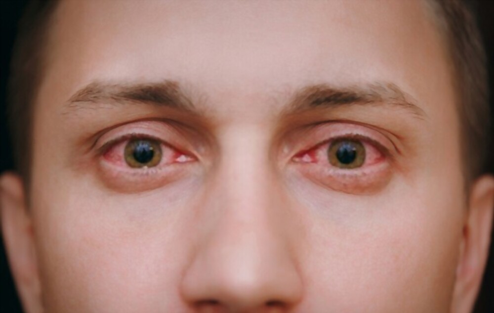 Corneal epithelial defect redness