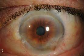 Limbal stem cell deficiency