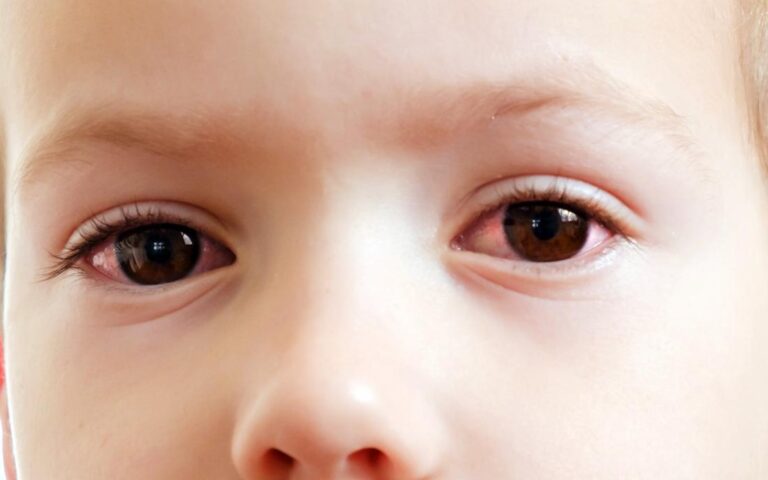 Eye Allergies in children