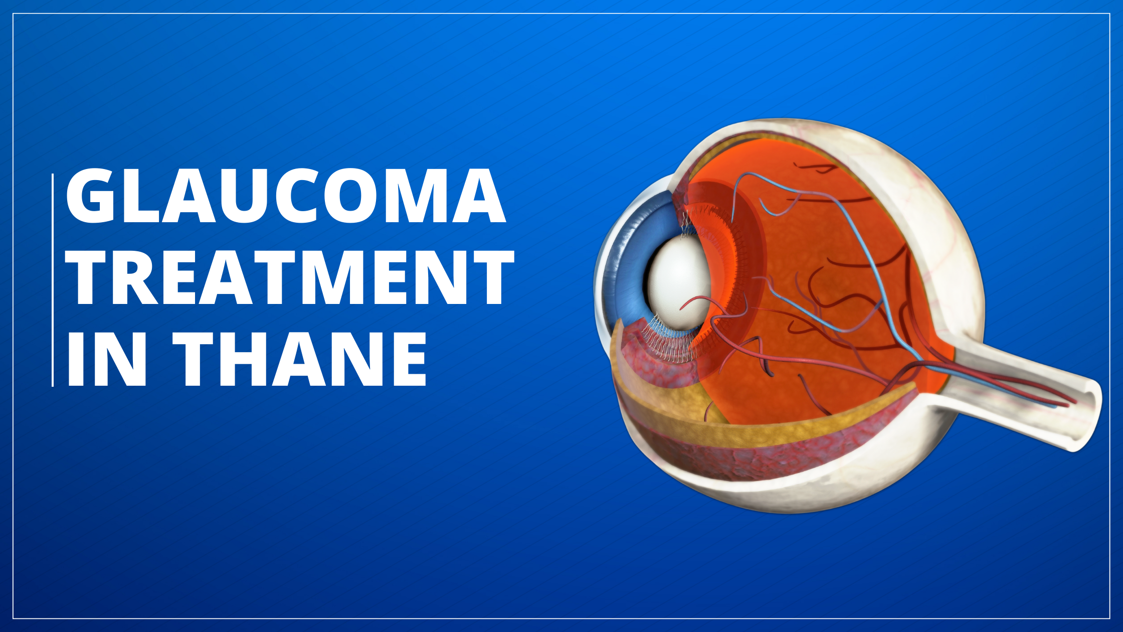 Glaucoma Treatment in Thane