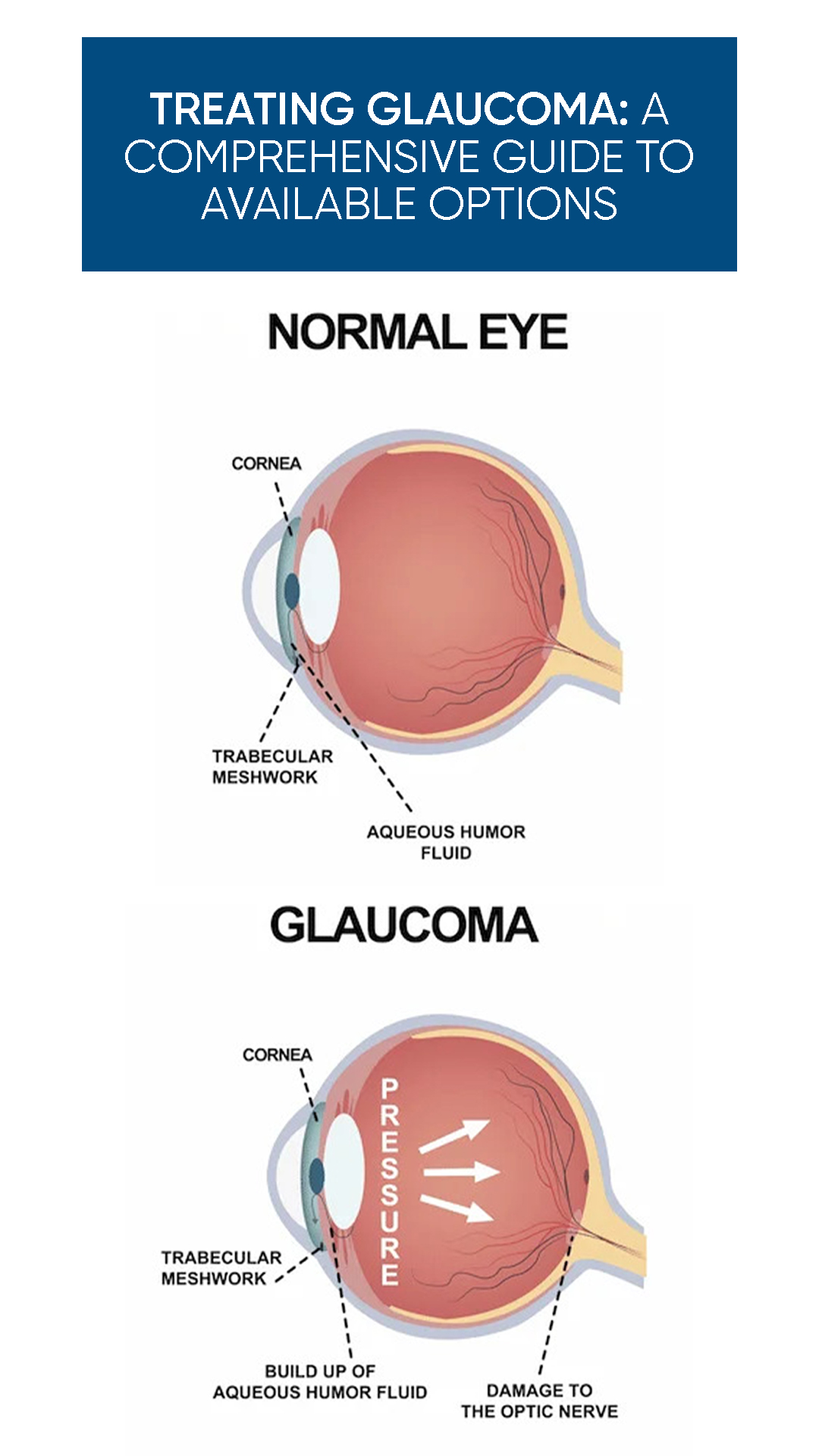 Treating Glaucoma