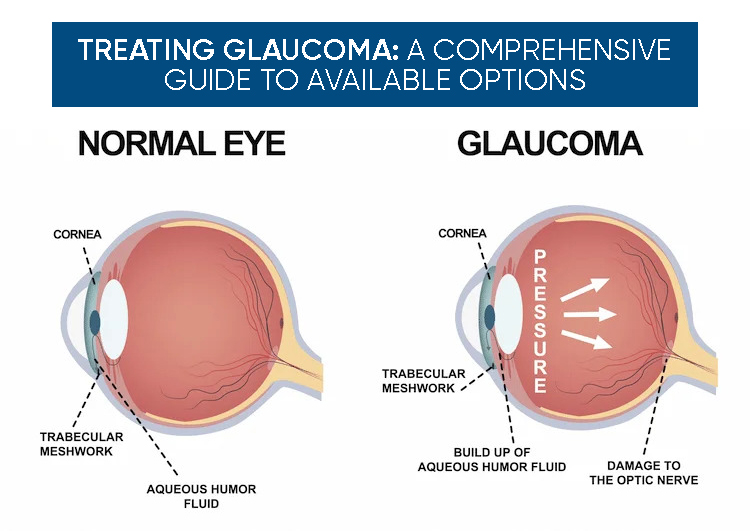 Treating Glaucoma