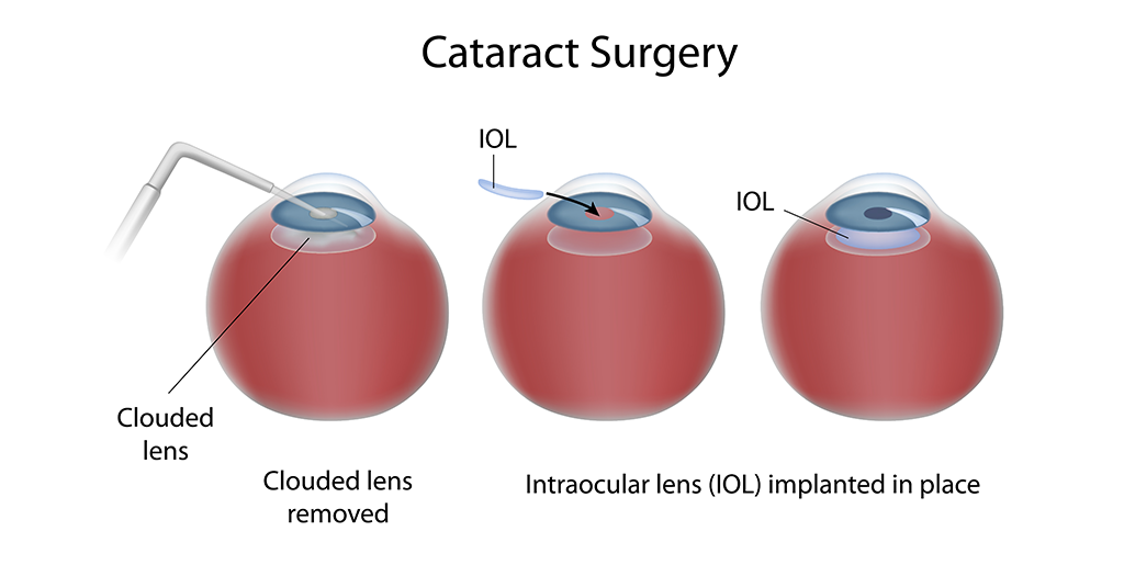 TYPES OF CATARACT SURGERY