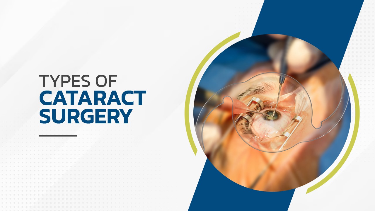 Types of Cataract Surgery