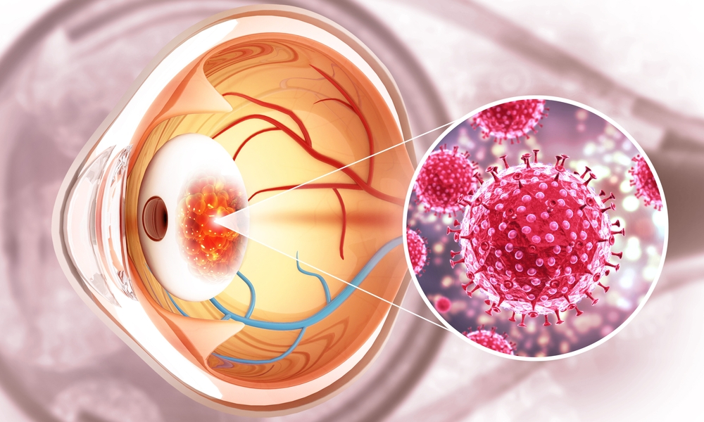 Eye,Disease,,Eye,Cancer,,3d,Illustration